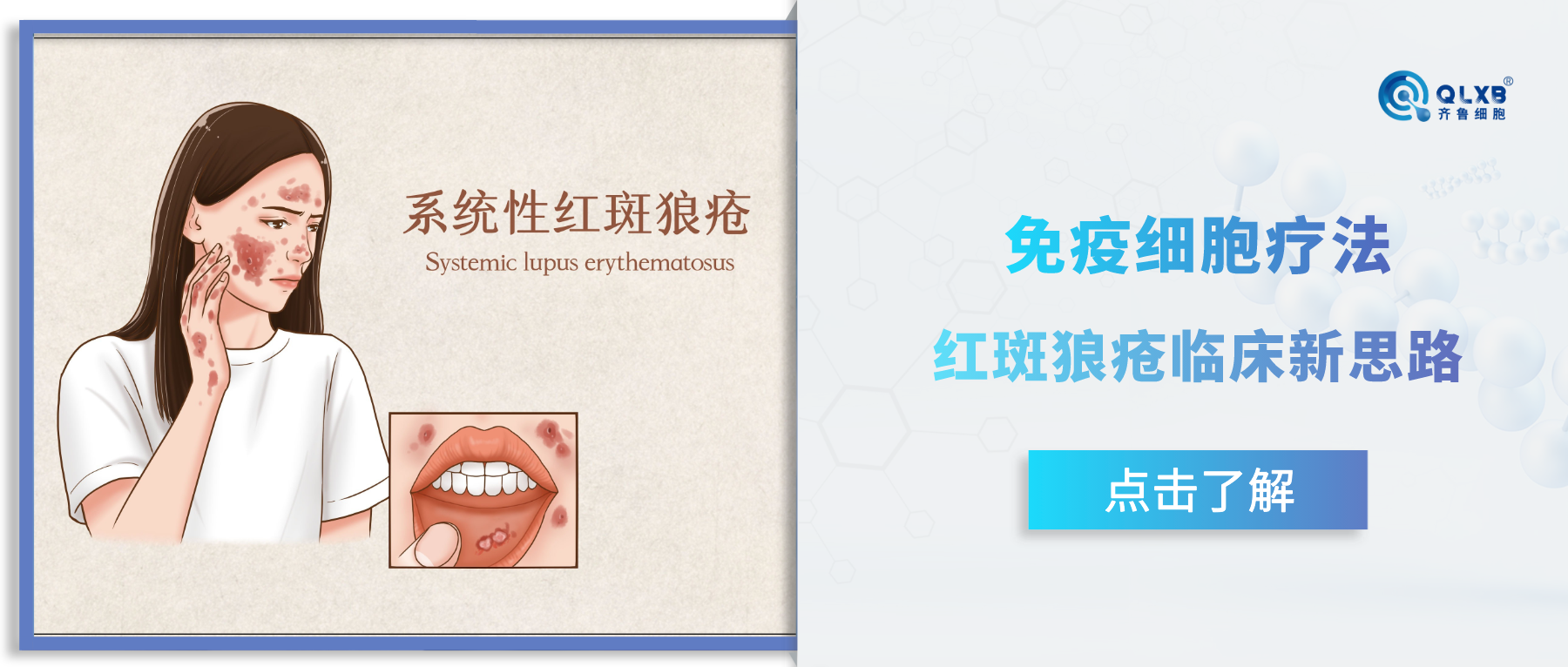 免疫细胞疗法：红斑狼疮的临床新思路