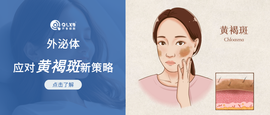 令女性朋友“头疼”的黄褐斑，外泌体或可成为应对新策略